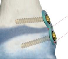 8-подібна арочно-мостовидна пластина, відстань між отворами 16мм, з двома канюльованими гвинтами діаметром 4.5мм ( Double Medical Technology Inc.)